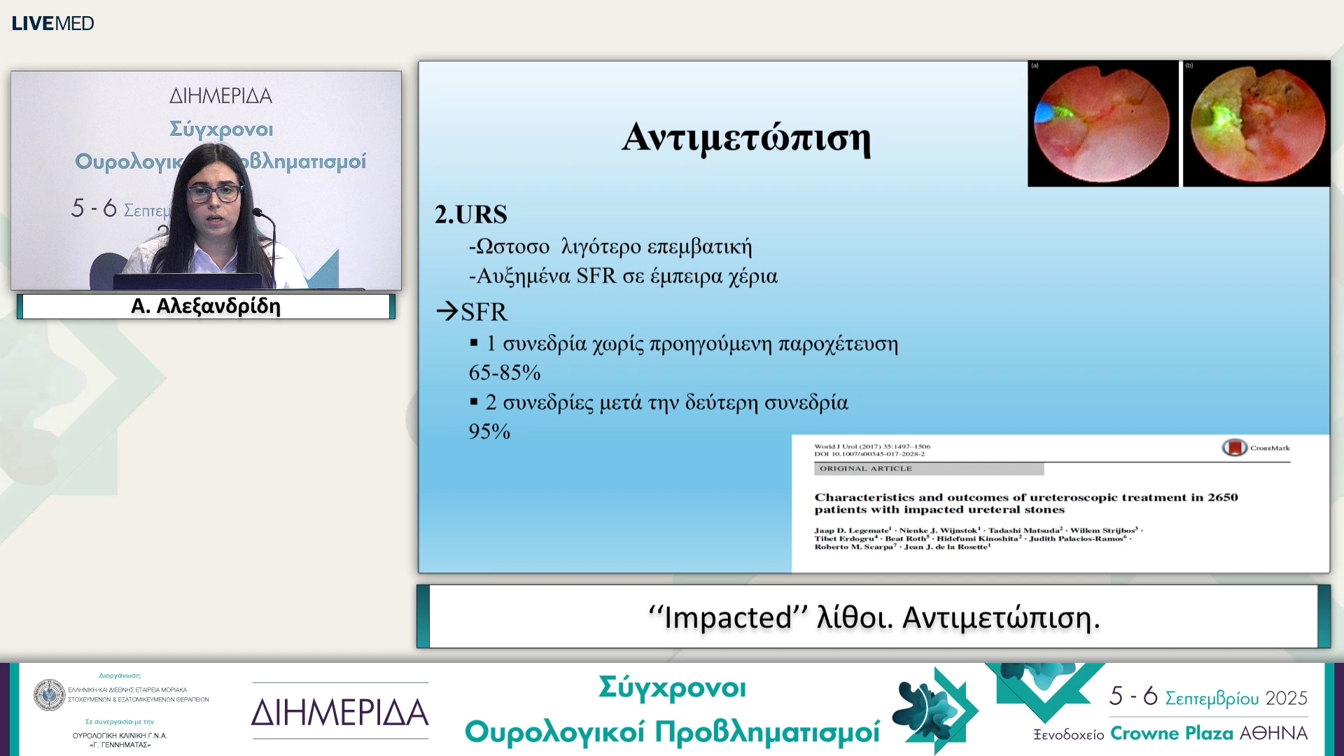 42 Α. Αλεξανδρίδη - ‘‘Impacted’’ λίθοι. Αντιμετώπιση