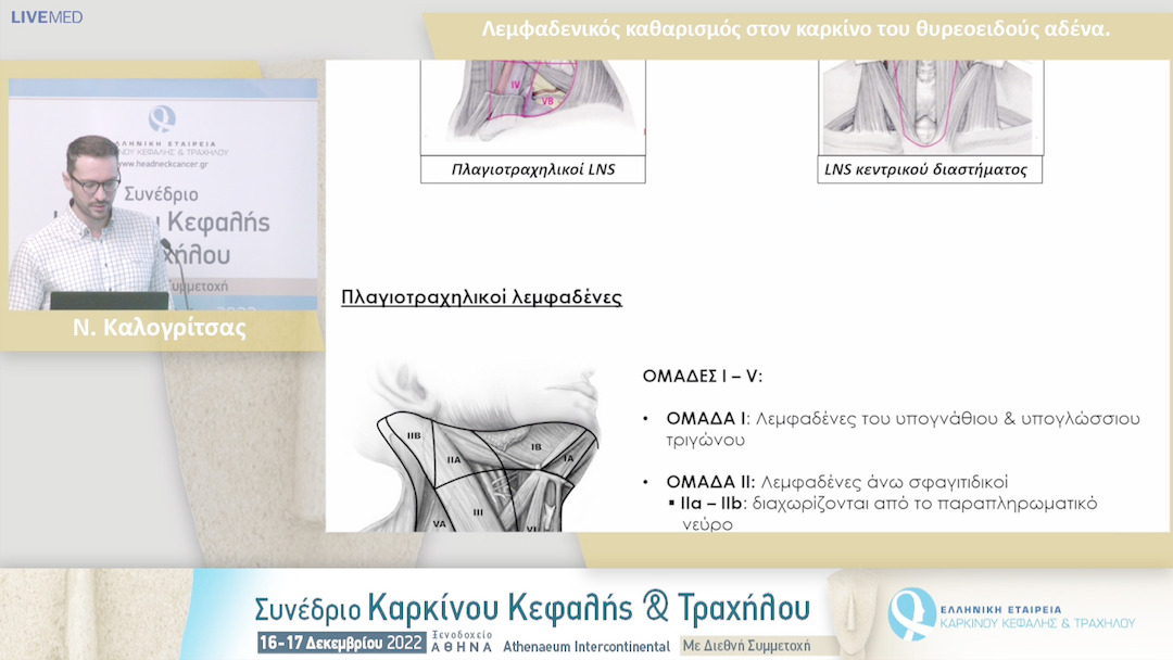 44 Ν. Καλογρίτσας - Λεμφαδενικός καθαρισμός στον καρκίνο του θυρεοειδούς αδένα.