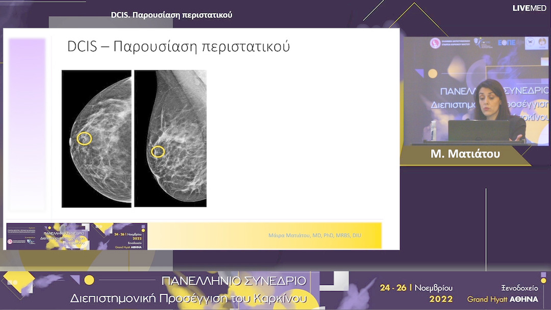 37 Μ. Ματιάτου - DCIS. Παρουσίαση περιστατικού