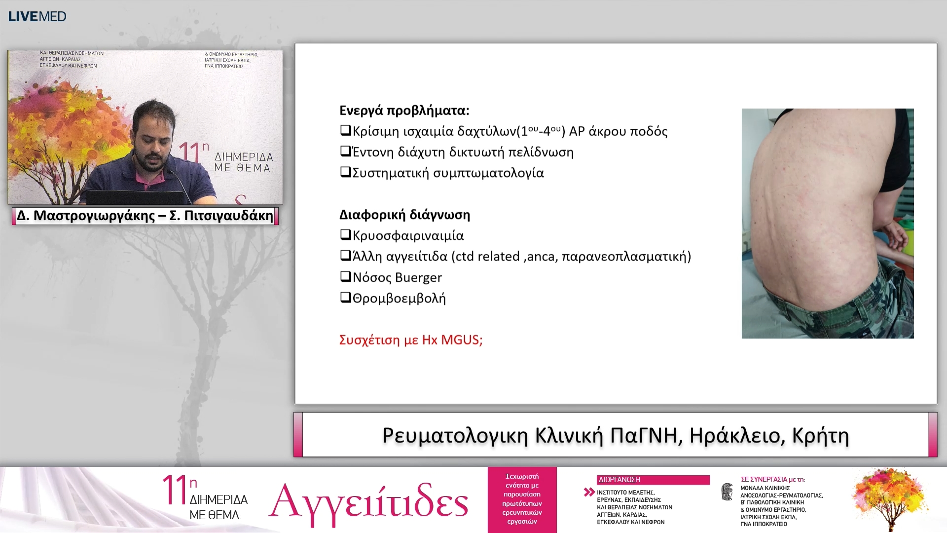 31 Δ. Μαστρογιωργάκης – Σ. Πιτσιγαυδάκη Ρευματολογικη Κλινική ΠαΓΝΗ, Hράκλειο, Κρήτη