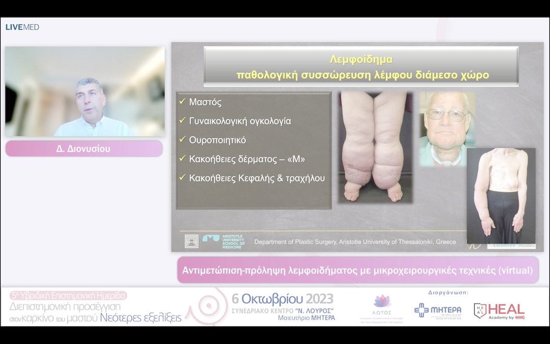 28 Δ. Διονυσίου - Αντιμετώπιση-πρόληψη λεμφοιδήματος με μικροχειρουργικές τεχνικές 