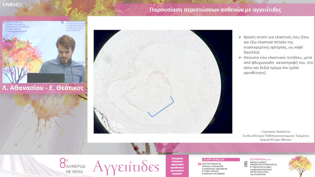 34 Λ. Αθανασίου - Ε. Θεότικος - Παρουσίαση περιπτώσεων ασθενών με αγγειίτιδες