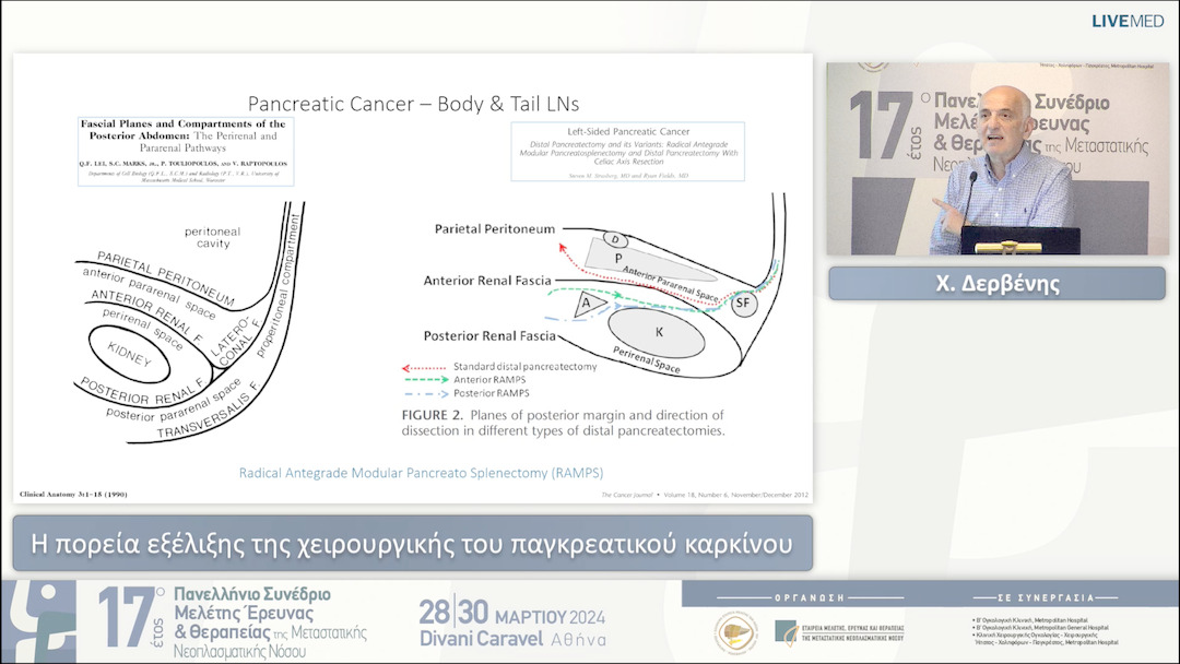 28 Χ. Δερβένης - Η πορεία εξέλιξης της χειρουργικής του παγκρεατικού καρκίνου 