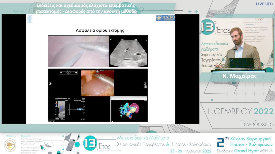 21 Ν. Μαχαίρας - Ενδείξεις και σχεδιασμός ελάχιστα επεμβατικής ηπατεκτομής - Διαφορές από την ανοικτή μέθοδο 