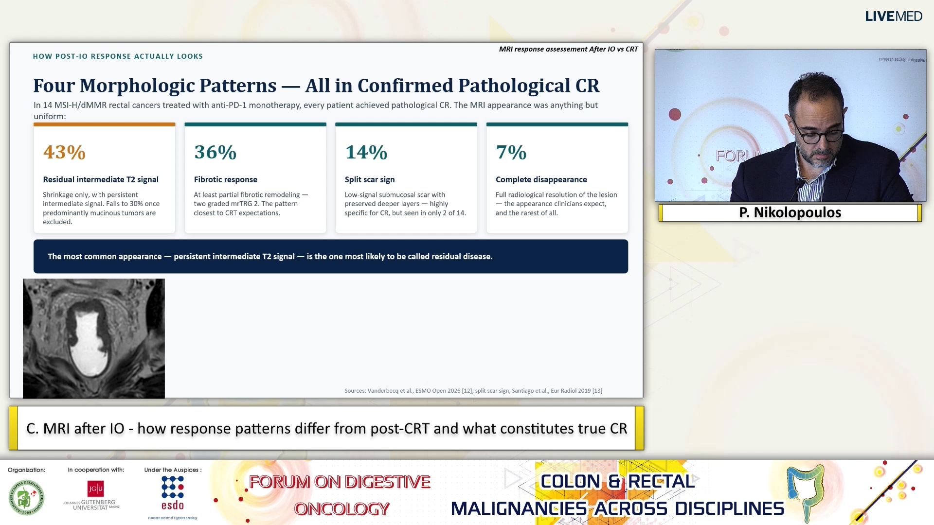 40 P. Nikolopoulos - C. MRI after IO - how response patterns differ from post-CRT and what constitutes true CR. 