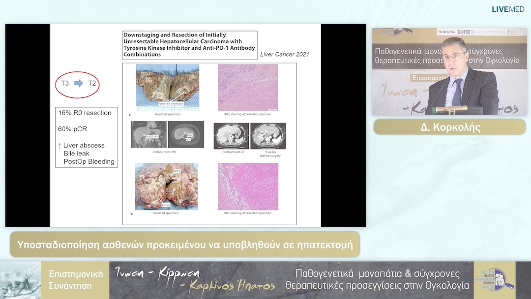 44 Δ. Κορκολής - Υποσταδιοποίηση ασθενών προκειμένου να υποβληθούν σε ηπατεκτομή 