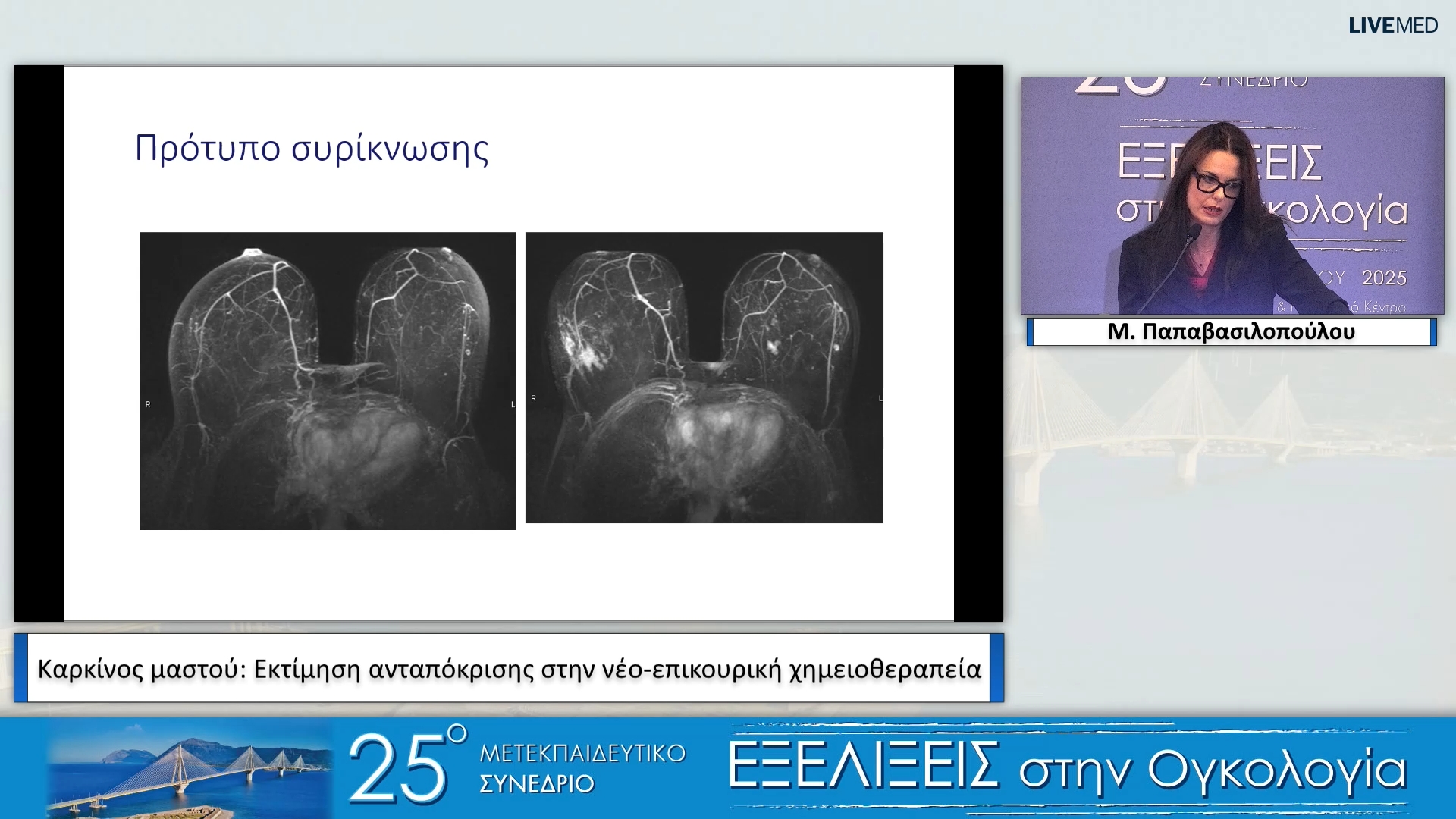28 Μ. Παπαβασιλοπούλου - Καρκίνος μαστού: Εκτίμηση ανταπόκρισης στη νέο-επικουρική χημειοθεραπεία