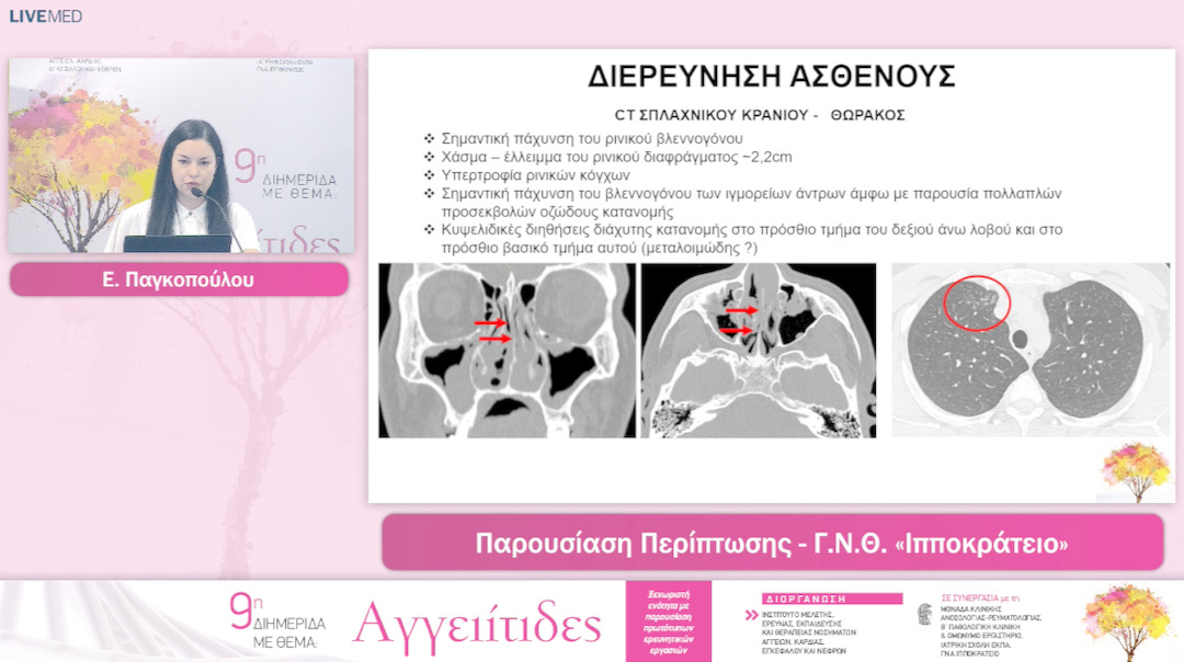 29 Ε. Παγκοπούλου - Θ.Δημητρούλας - Παρουσιαση - Συζητηση Περιπτωσεων Ασθενων Με Αγγειιτιδες