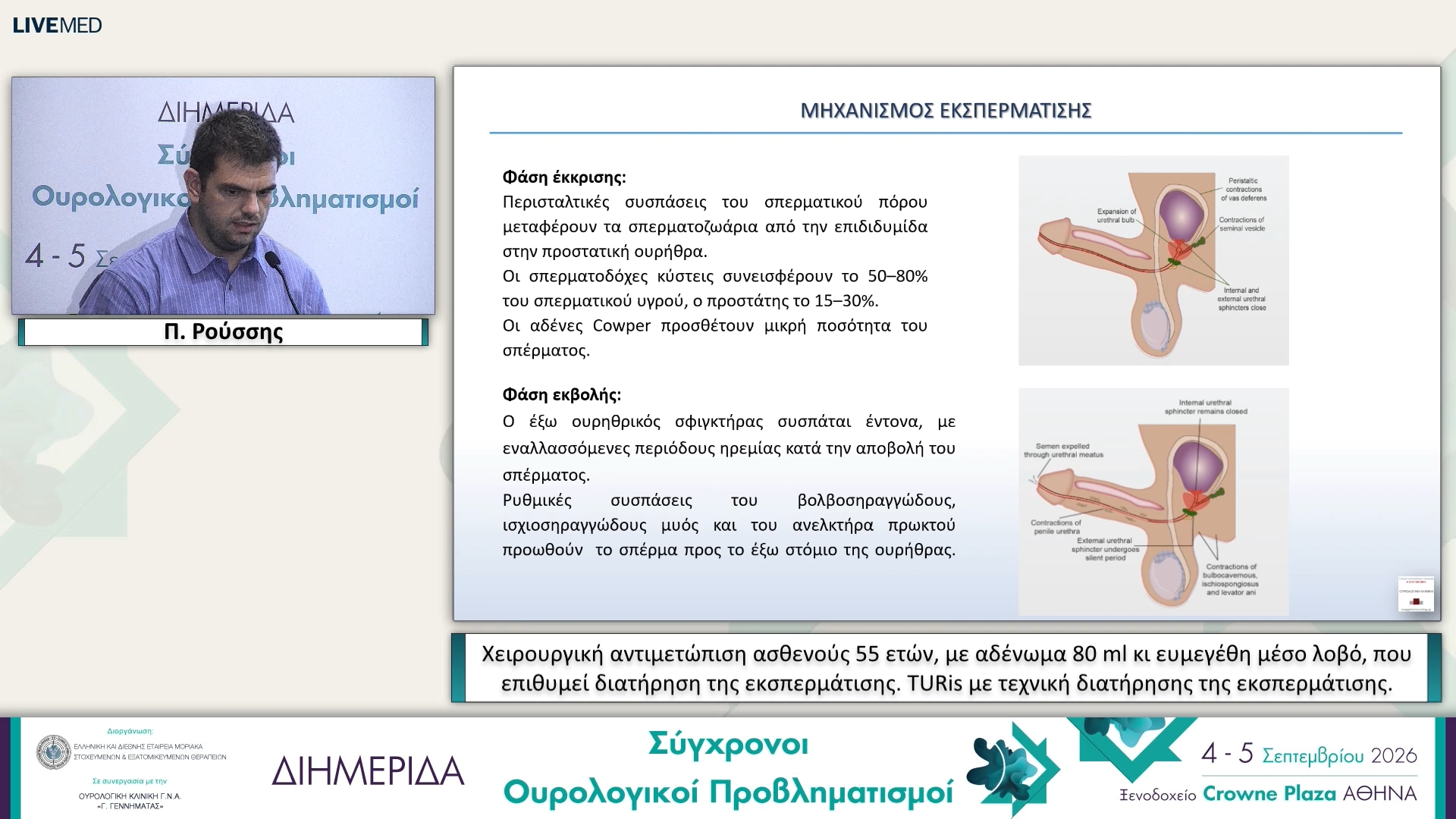 46 Π. Ρούσσης - TURis με τεχνική διατήρησης της εκσπερμάτισης. 