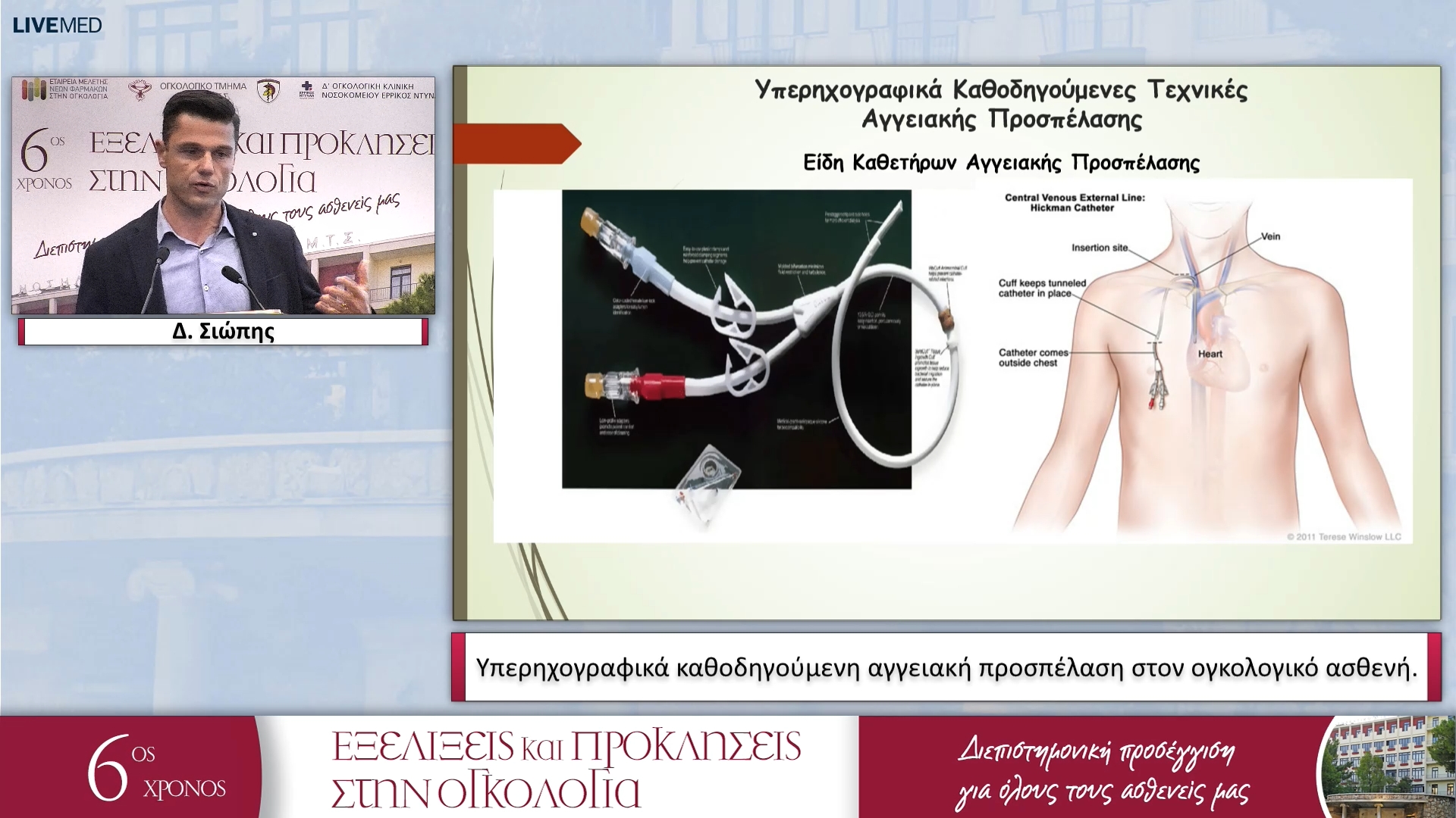 36 Δ. Σιώπης - Υπερηχογραφικά καθοδηγούμενη αγγειακή προσπέλαση στον ογκολογικό ασθενή. 