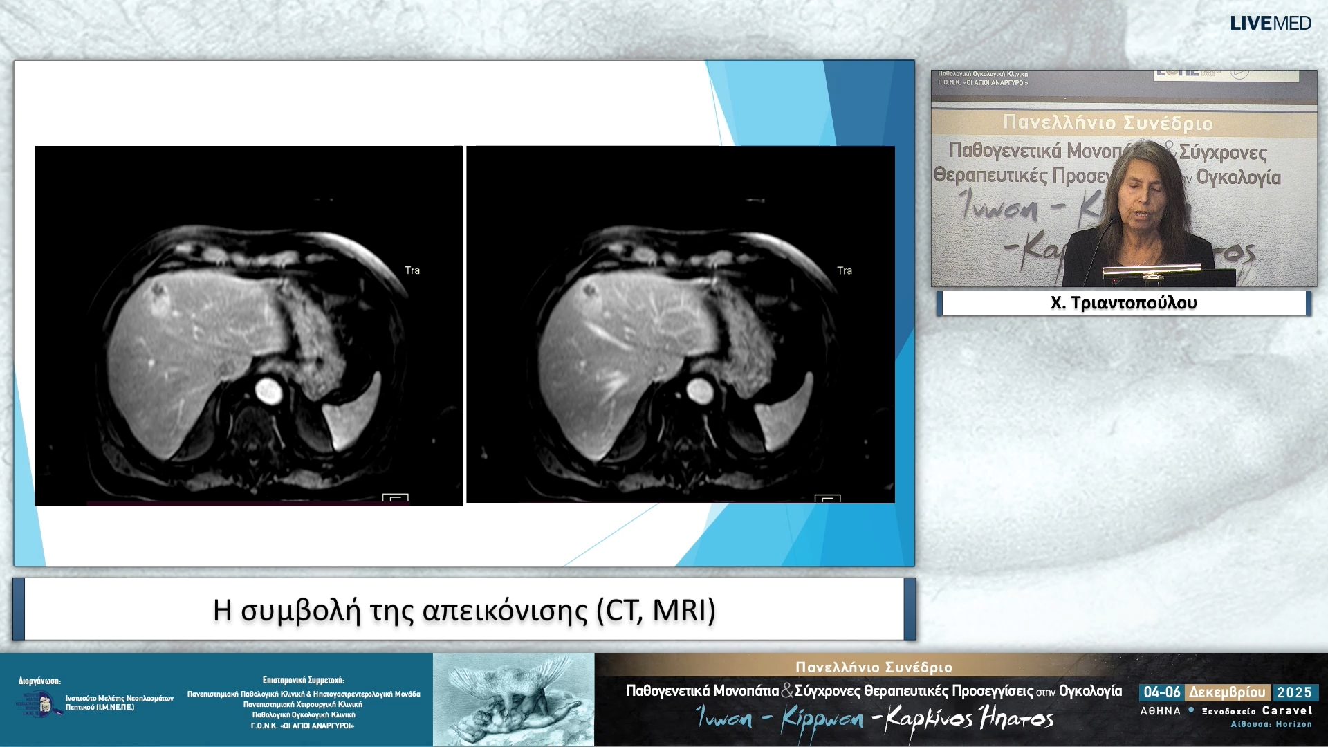 37 Χ. Τριαντοπούλου - Η συμβολή της απεικόνισης (CT, MRI)