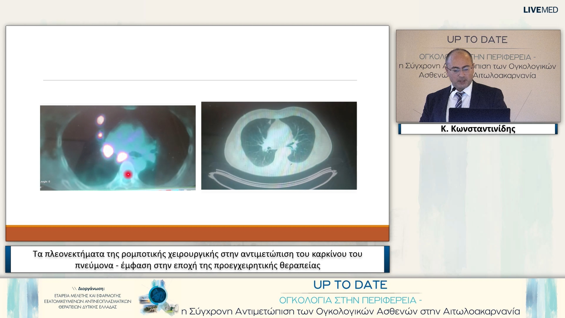 19 Κ. Κωνσταντινίδης - Τα πλεονεκτήματα της ρομποτικής χειρουργικής στην αντιμετώπιση του καρκίνου του πνεύμονα - έμφαση στην εποχή της προεγχειρητικής θεραπείας