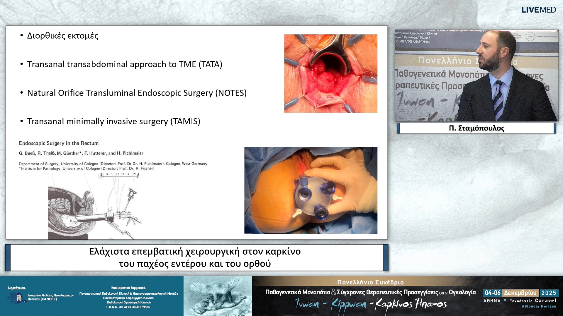 21 Π. Σταμόπουλος - Ελάχιστα επεμβατική χειρουργική στον καρκίνο του παχέος εντέρου και του ορθού