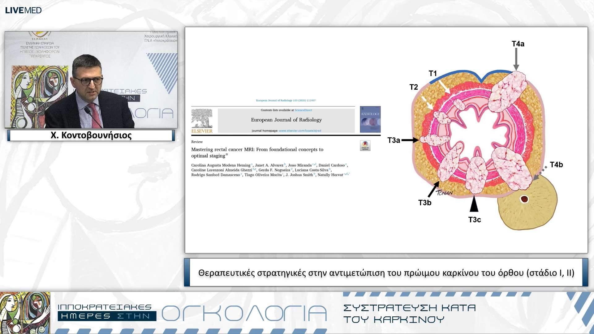 46 Χ. Κοντοβουνήσιος - Θεραπευτικές στρατηγικές στην αντιμετώπιση του πρώιμου καρκίνου του όρθου (στάδιο Ι, ΙΙ)