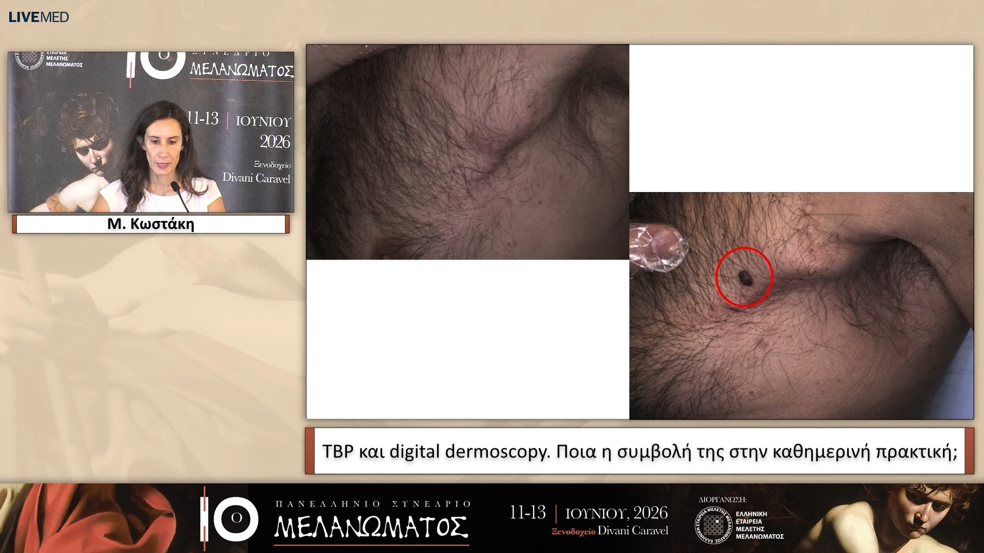 06 Μ. Κωστάκη - ΤΒP και digital dermoscopy. Ποια η συμβολή της στης καθημερινή πρακτική; 