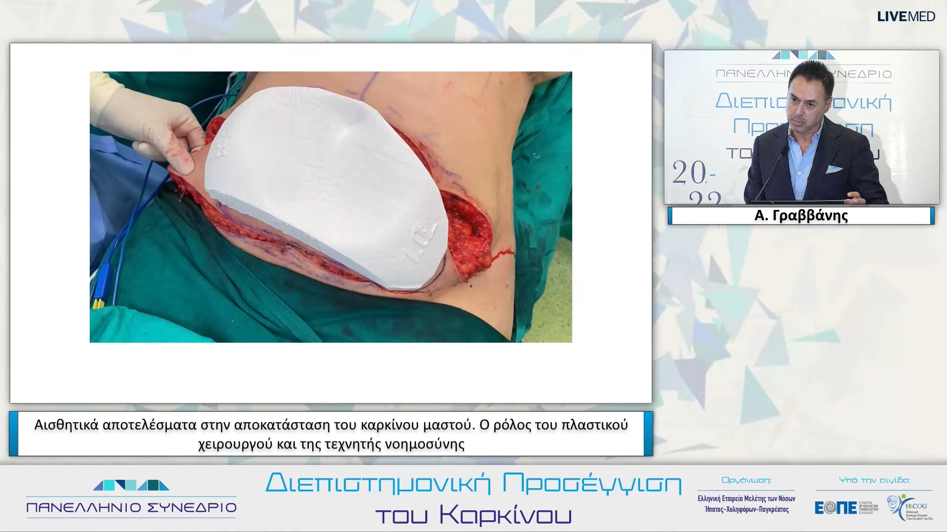 51 Α. Γραββάνης - Αισθητικά αποτελέσματα στην αποκατάσταση του καρκίνου μαστού. Ο ρόλος του πλαστικού χειρουργού και της τεχνητής νοημοσύνης.