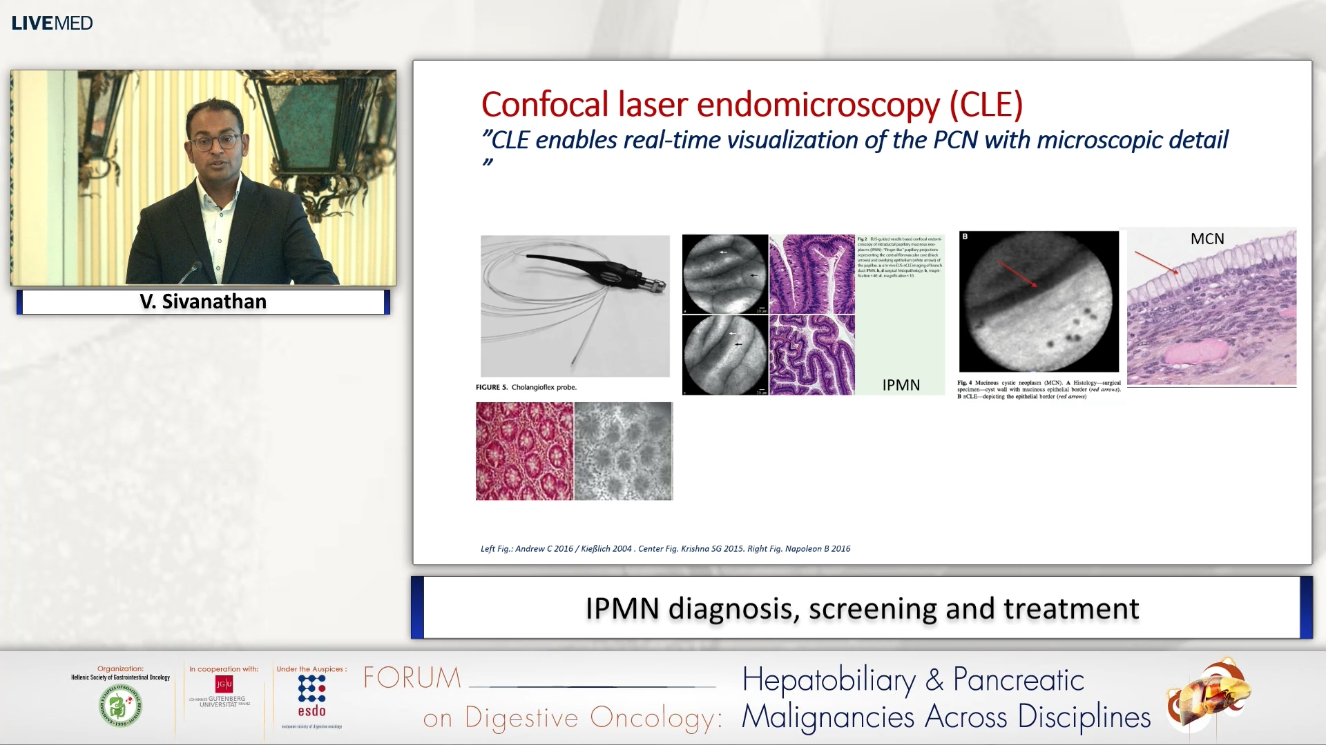 30 V. Sivanathan - IPMN diagnosis, screening and treatment