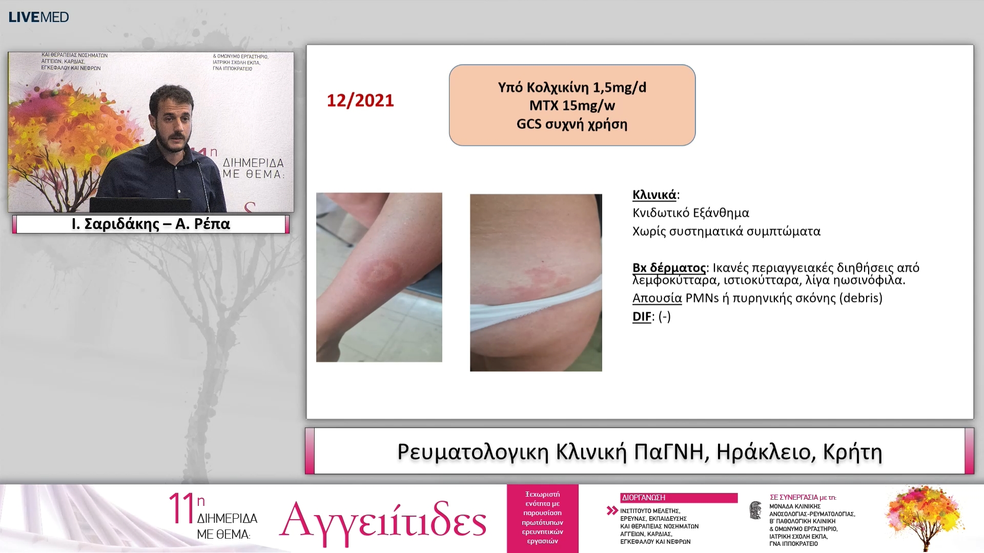 32 Ι. Σαριδάκης – Α. Ρέπα Ρευματολογικη Κλινική ΠαΓΝΗ, Hράκλειο, Κρήτη