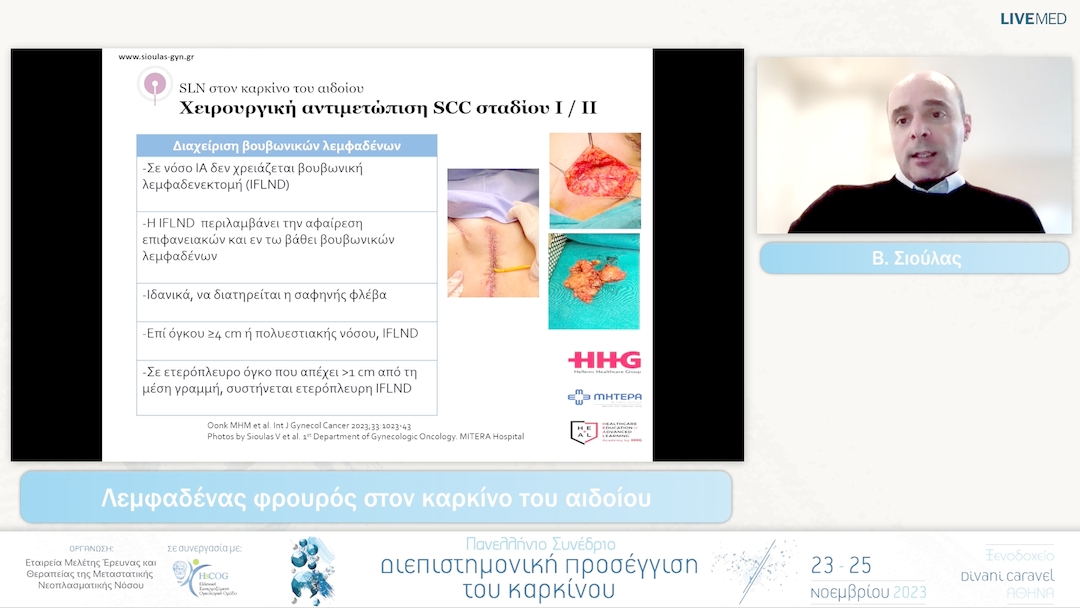 59 Β. Σιούλας - Λεμφαδένας φρουρός στον καρκίνο του αιδοίου 