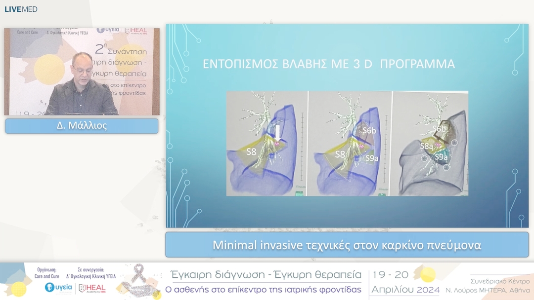 35 Δ. Μάλλιος - Minimal invasive τεχνικές στον καρκίνο πνεύμονα 