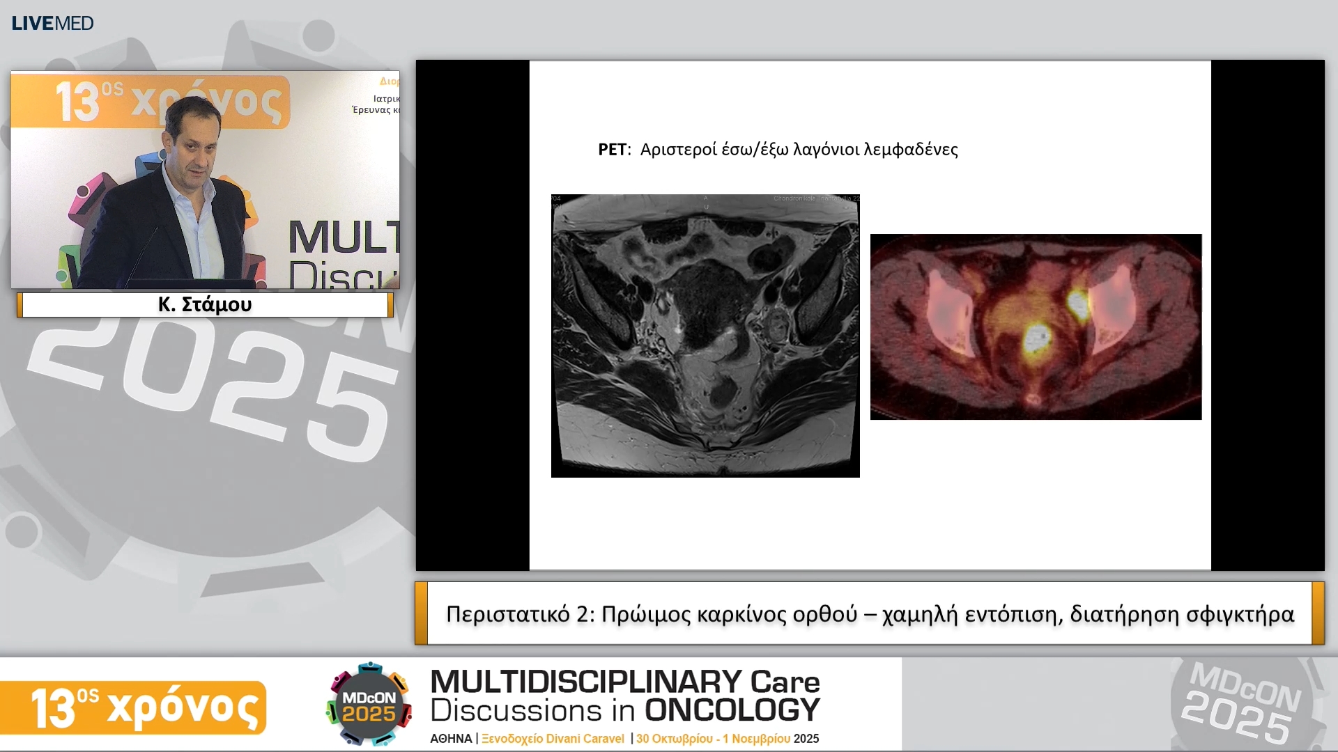 55 Κ. Στάμου • Περιστατικό 2: Πρώιμος καρκίνος ορθού – χαμηλή εντόπιση, διατήρηση σφιγκτήρα
