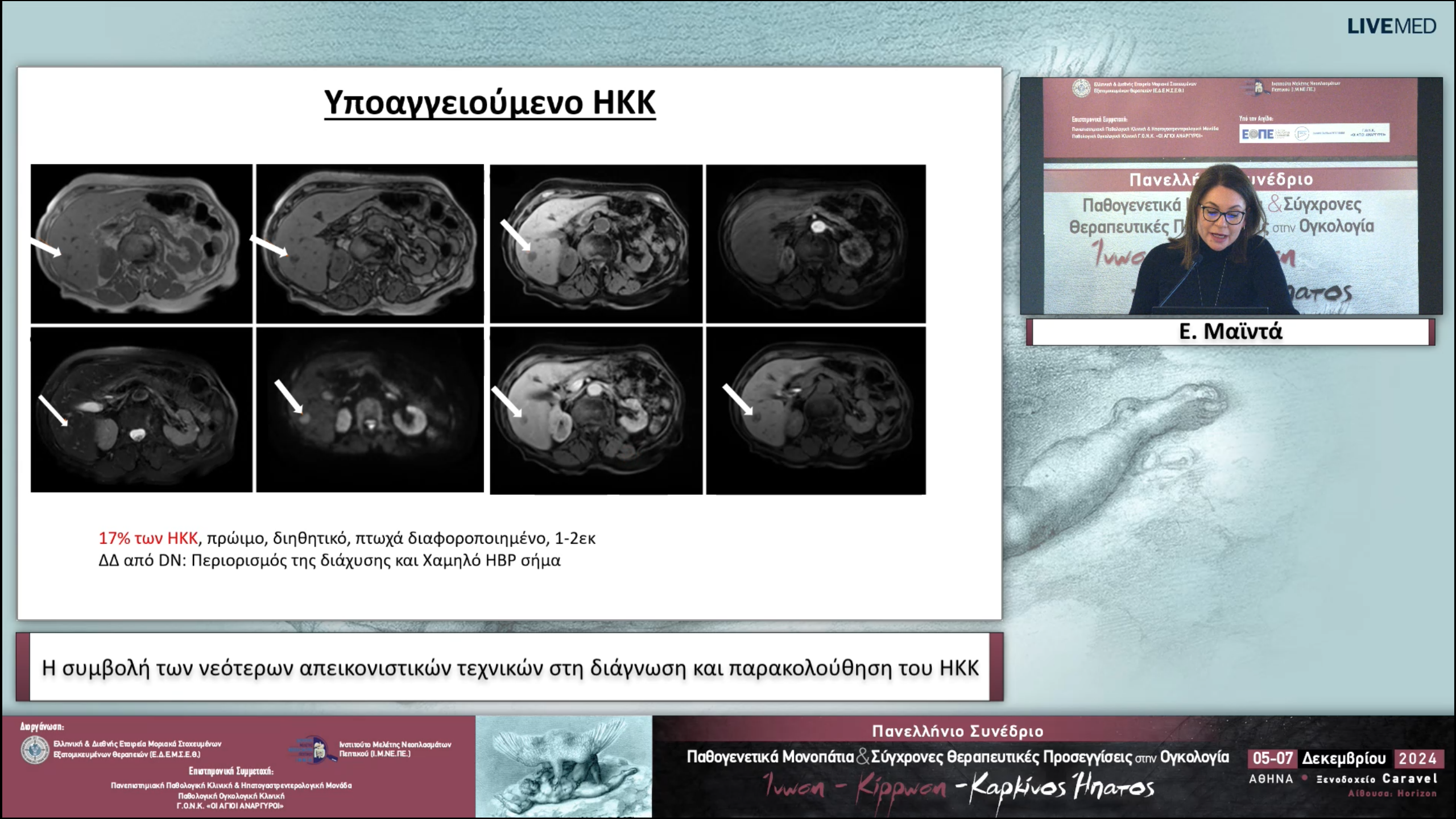 50 Ε. Μαϊντά - Η συμβολή των νεότερων απεικονιστικών τεχνικών στη διάγνωση και παρακολούθηση του ΗΚΚ