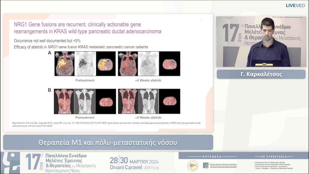 27 Γ. Καρκαλέτσος - Θεραπεία Μ1 και πόλυ-μεταστατικής νόσου 