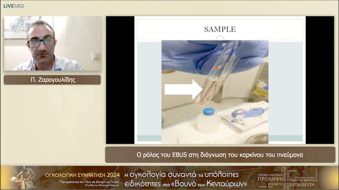 23 Π. Ζαρογουλίδης - Ο ρόλος του ΕBUS στη διάγνωση του καρκίνου του πνεύμονα 