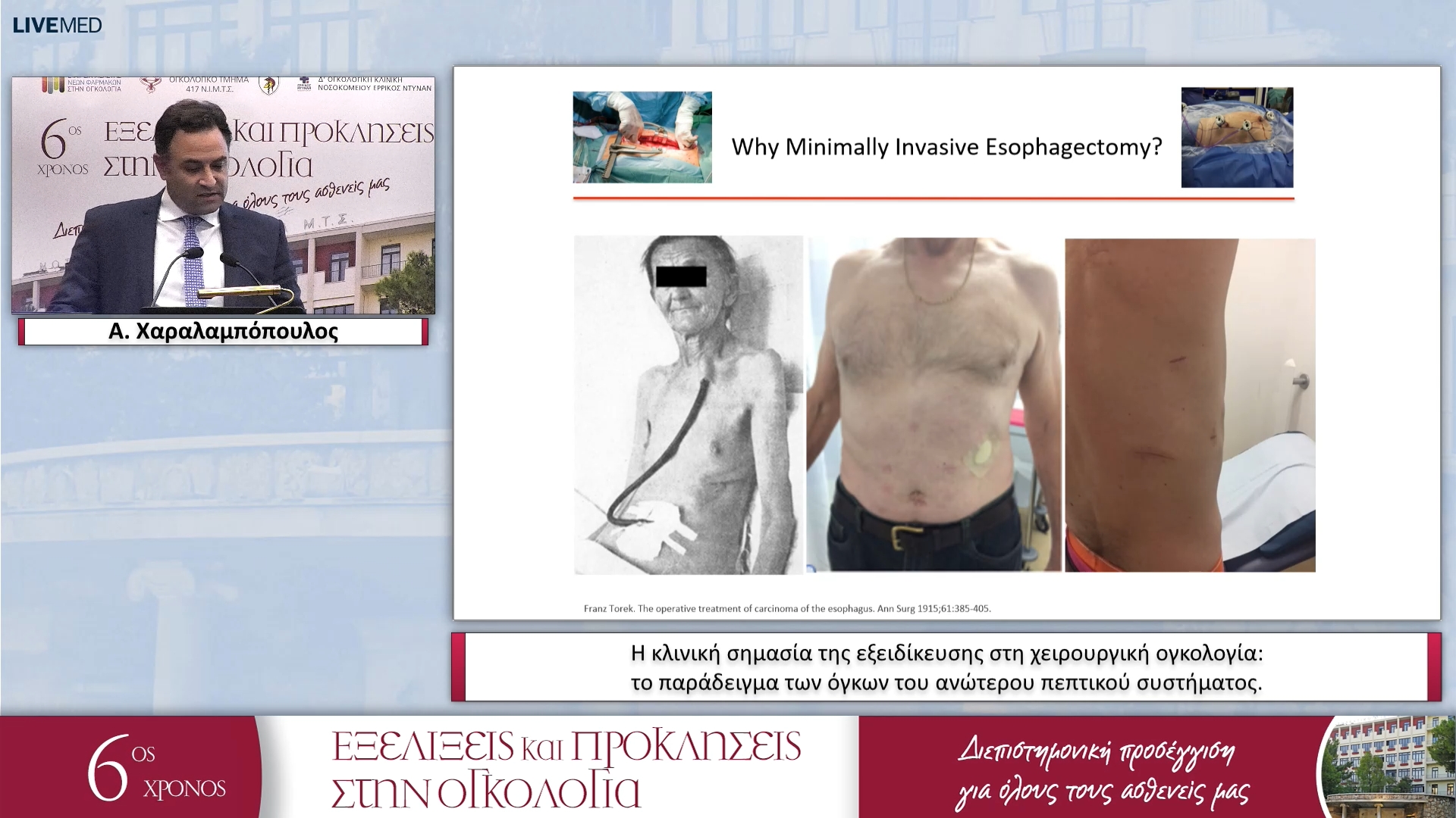 26 Α. Χαραλαμπόπουλος - Η κλινική σημασία της εξειδίκευσης στη χειρουργική ογκολογία: το παράδειγμα των όγκων του ανώτερου πεπτικού συστήματος. 