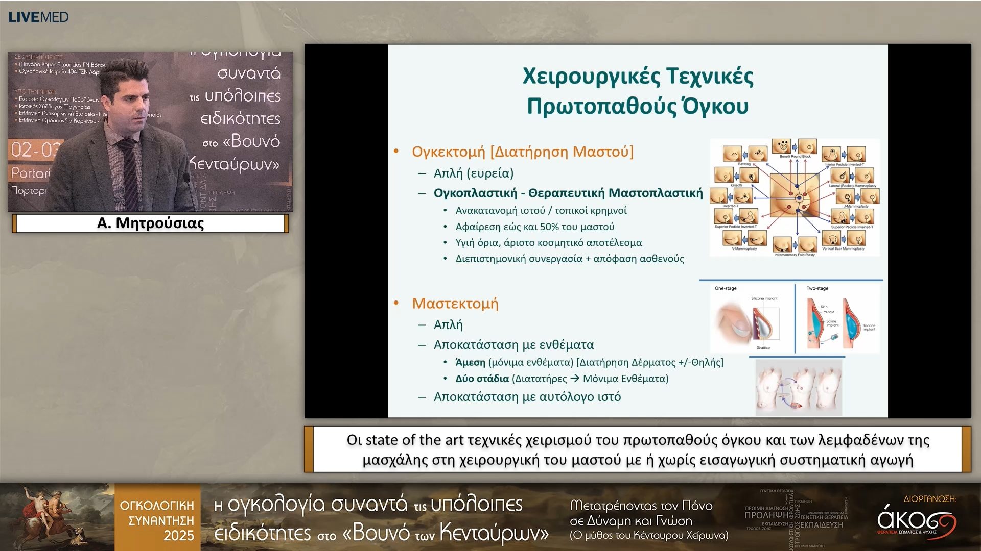 43 Α. Μητρούσιας - Οι state of the art τεχνικές χειρισμού του πρωτοπαθούς όγκου και των λεμφαδένων της μασχάλης στη χειρουργική του μαστού με ή χωρίς εισαγωγική συστηματική αγωγή 