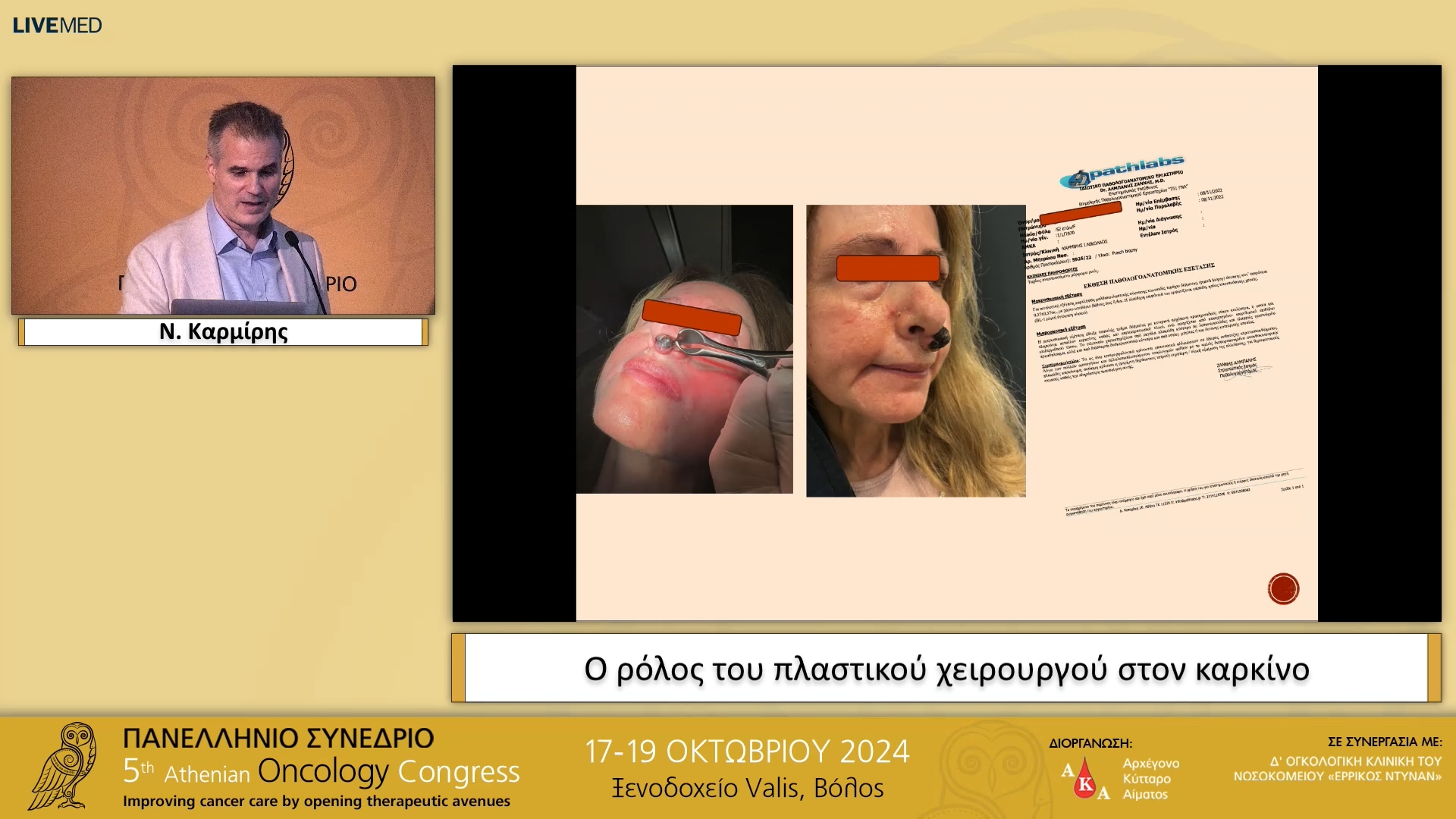 32 Ν. Καρμίρης - Ο ρόλος του πλαστικού χειρουργού στον καρκίνο 