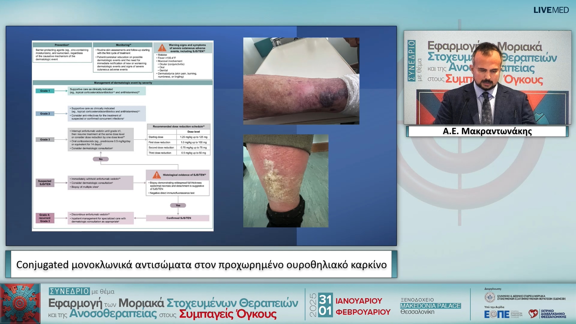 43  Α.Ε. Μακραντωνάκης - Conjugated μονοκλωνικά αντισώματα στον προχωρημένο ουροθηλιακό καρκίνο