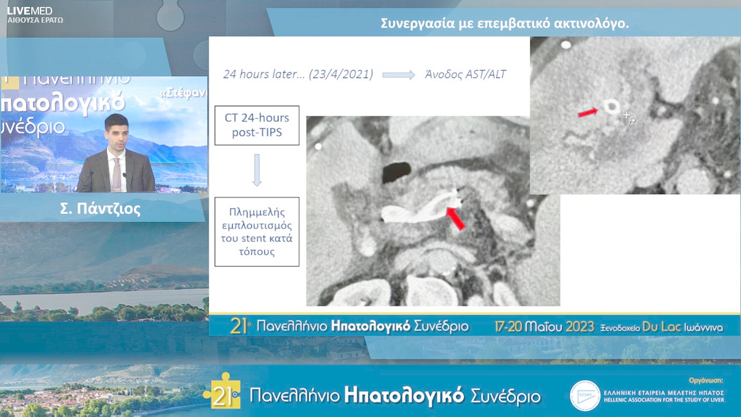 39  Σ. Πάντζιος, Ν. Πτώχης - Συνεργασία με επεμβατικό ακτινολόγο.