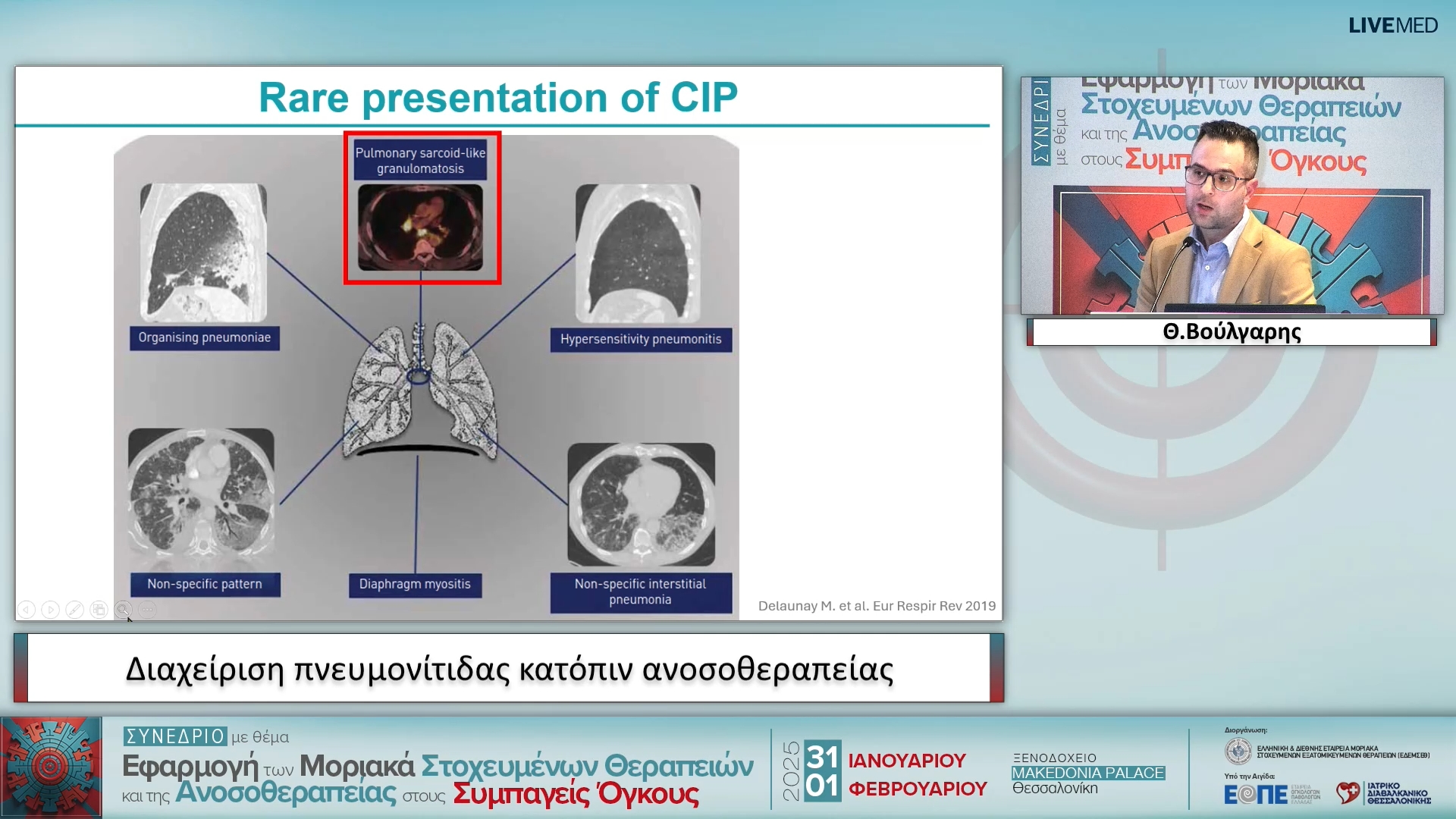 11 Θ. Βούλγαρης - Διαχείριση πνευµονίτιδας κατόπιν ανοσοθεραπείας 