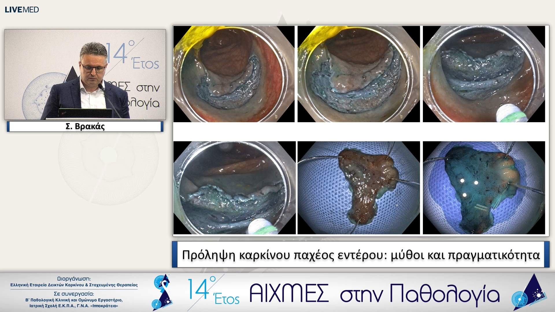 40 Σ. Βρακάς - Πρόληψη καρκίνου παχέος εντέρου: μύθοι και πραγματικότητα 