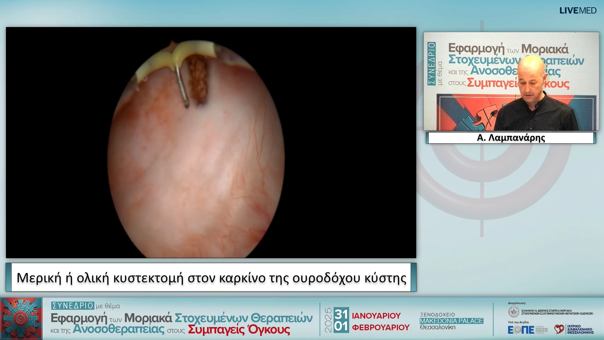 41 Α. Λαμπανάρης - Μερική ή ολική κυστεκτομή στον καρκίνο της ουροδόχου κύστης