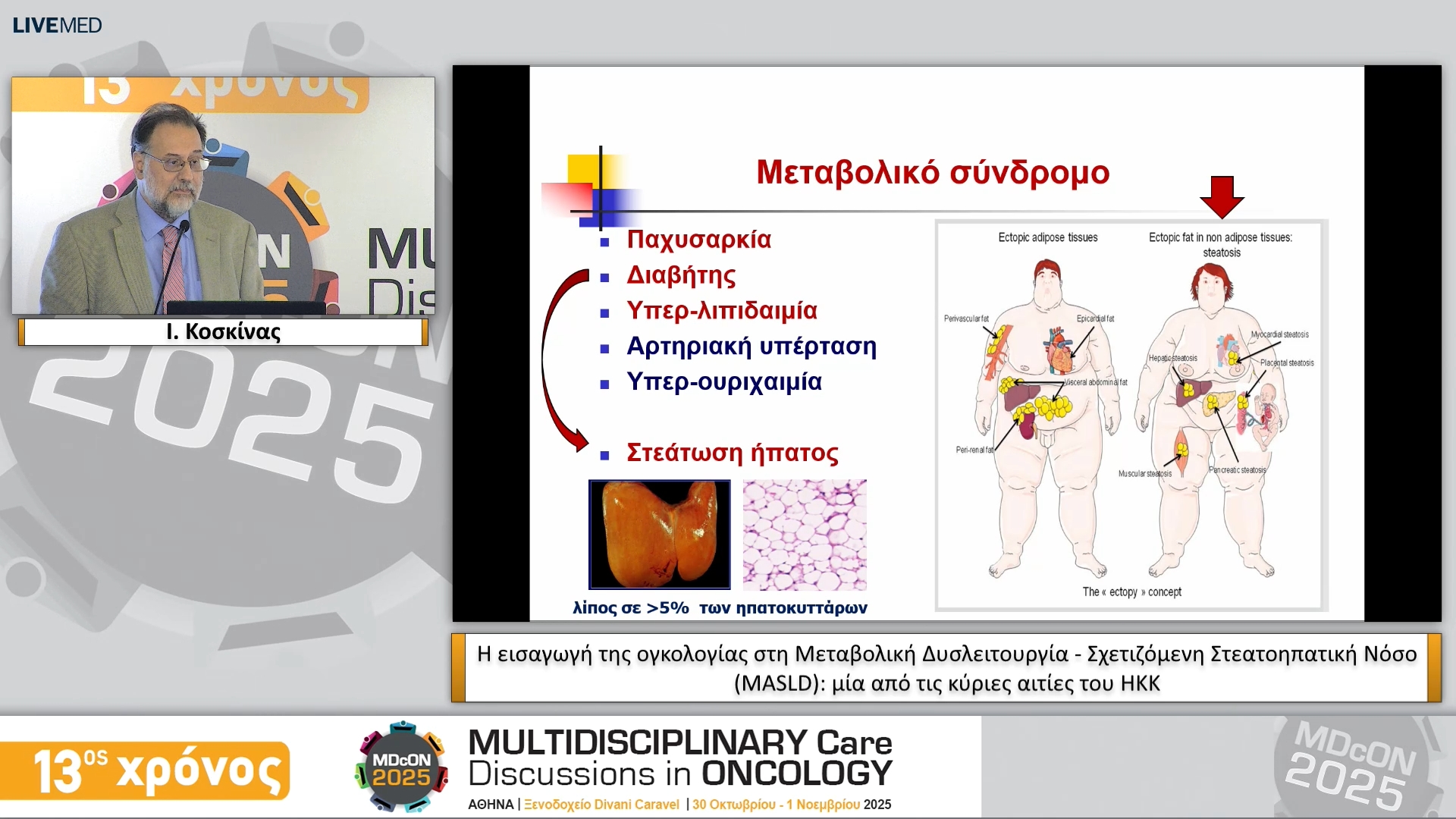 25 Ι. Κοσκίνας - Η εισαγωγή της ογκολογίας στη Μεταβολική Δυσλειτουργία - Σχετιζόμενη Στεατοηπατική Νόσο (MASLD): μία από τις κύριες αιτίες του ΗΚΚ 