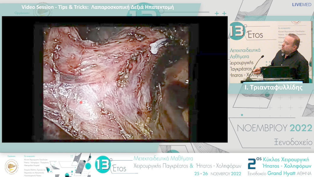 22 Ι. Τριανταφυλλίδης - Video Session - Tips & Tricks: Λαπαροσκοπική Δεξιά Ηπατεκτομή