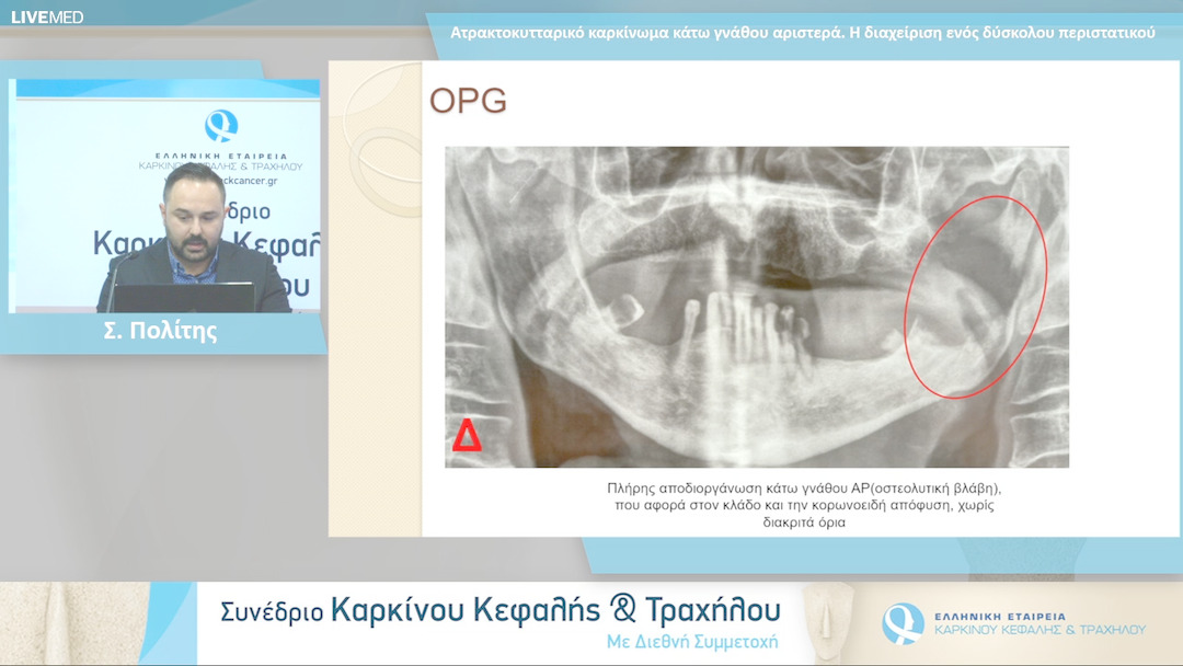 15 Σ. Πολίτης - Ατρακτοκυτταρικό καρκίνωμα κάτω γνάθου αριστερά. Η διαχείριση ενός δύσκολου περιστατικού 