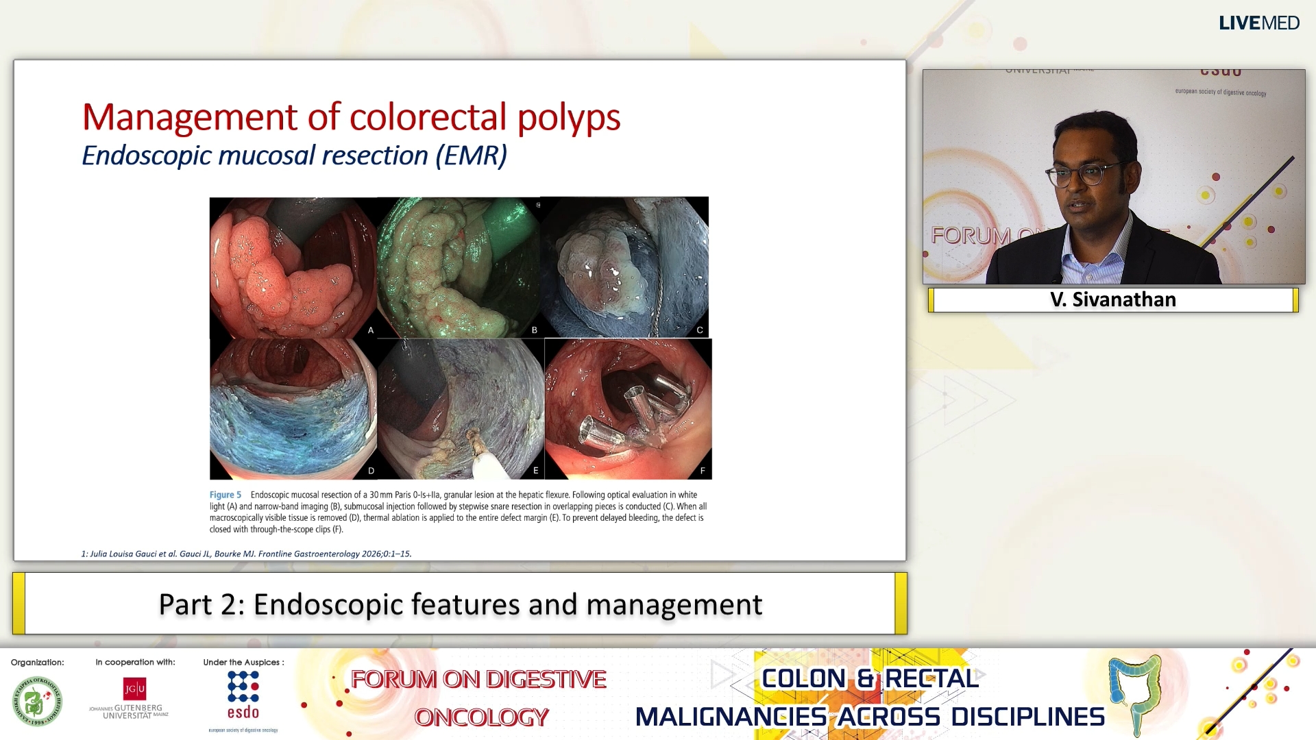 23 V. Sivanathan - Part 2: Endoscopic features and management.