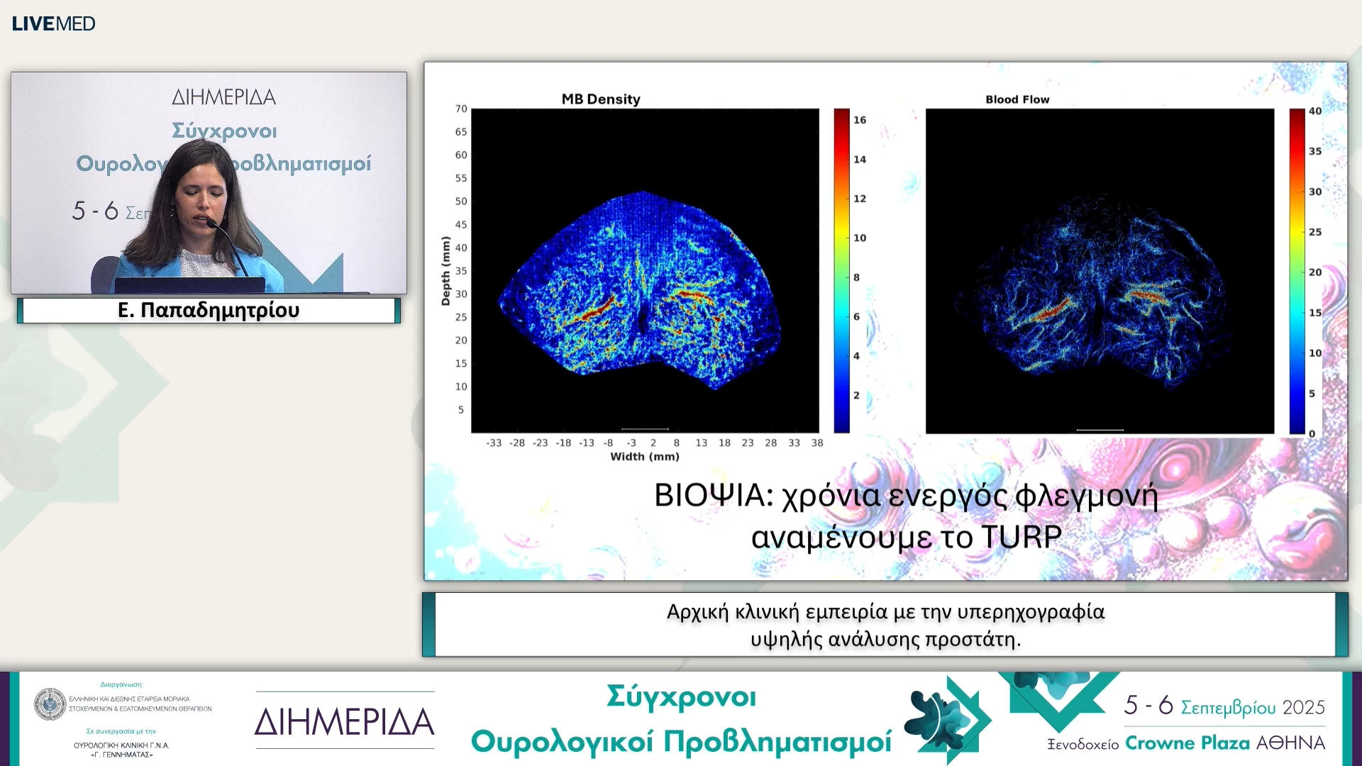 41  Ε. Παπαδημητρίου - Αρχική κλινική εμπειρία με την υπερηχογραφία υψηλής ανάλυσης προστάτη