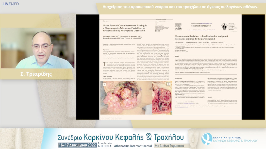 40 Σ. Τριαρίδης - Διαχείριση του προσωπικού νεύρου και του τραχήλου σε όγκους σιελογόνων αδένων.