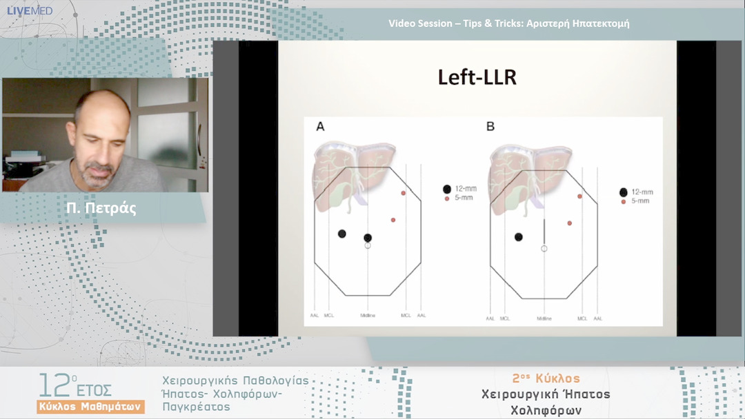 28 Π. Πετράς - Video Session – Tips & Tricks: Αριστερή Ηπατεκτομή 