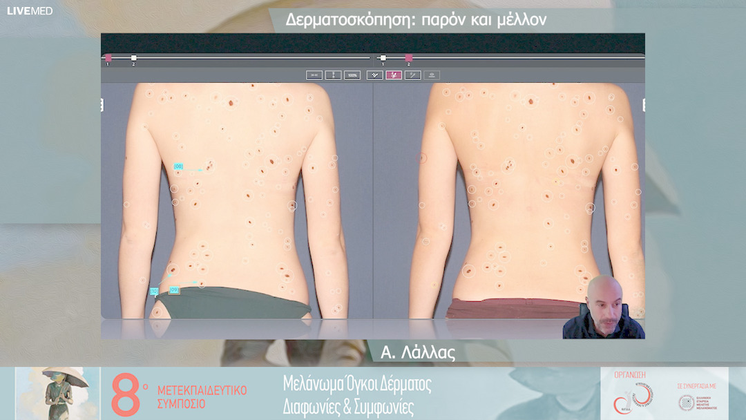 34 Α. Λάλλας - Δερματοσκόπηση: παρόν και μέλλον