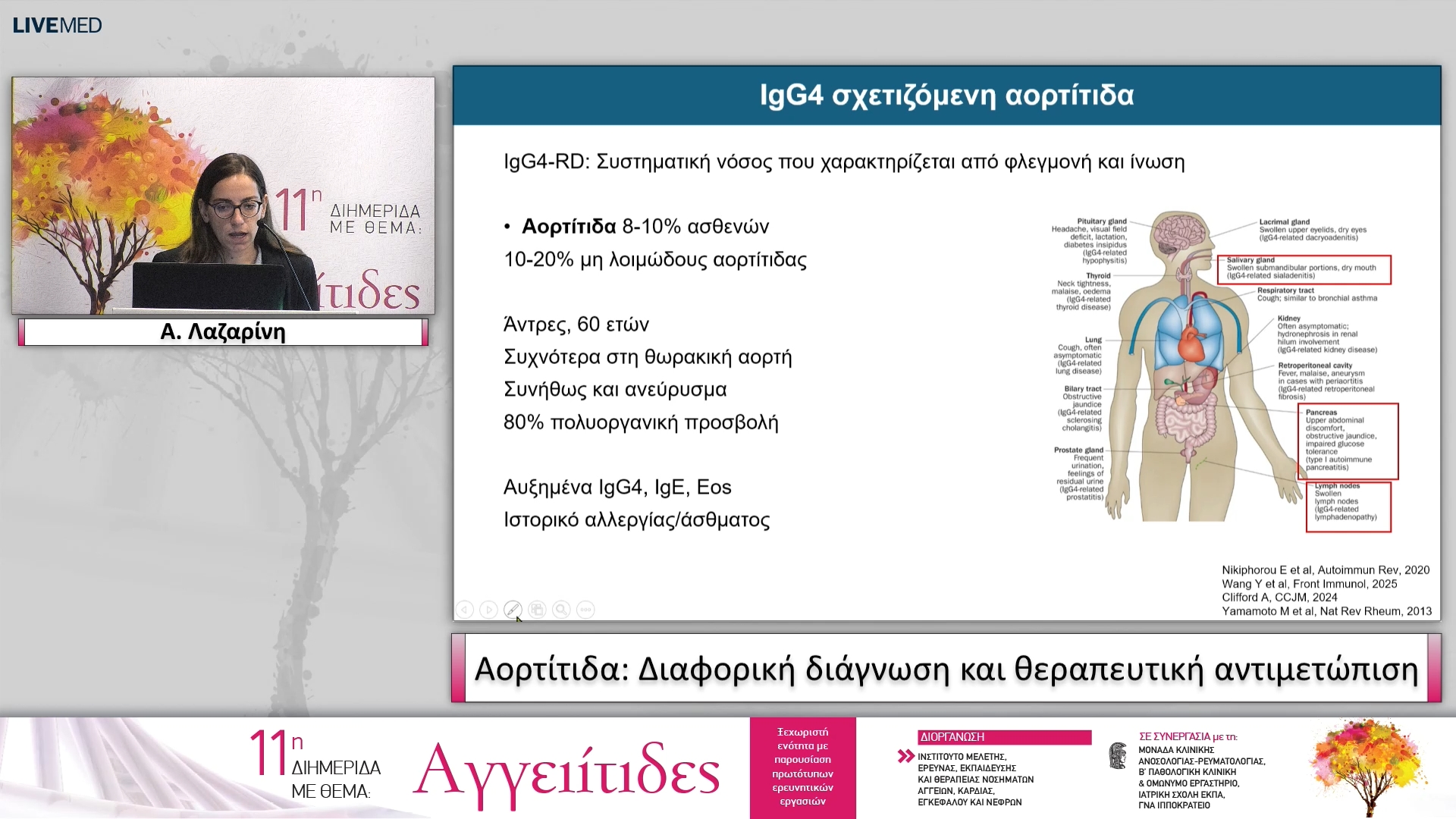 25 Α. Λαζαρίνη - Αορτίτιδα: Διαφορική διάγνωση και θεραπευτική αντιμετώπιση 