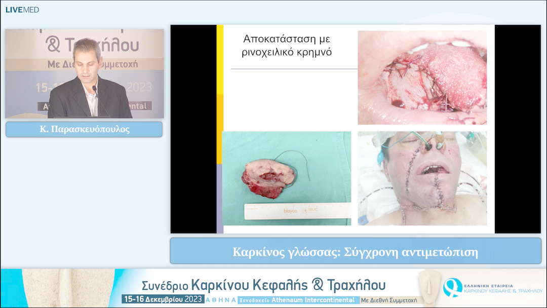 35 Κ. Παρασκευόπουλος - Καρκίνος γλώσσας: Σύγχρονη αντιμετώπιση 