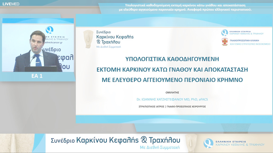 43 Ι. Χατζηστεφάνου - Υπολογιστικά καθοδηγούμενη εκτομή καρκίνου κάτω γνάθου και αποκατάσταση με ελεύθερο αγγειούμενο περονιαίο κρημνό. Αναφορά πρώτου ελληνικού περιστατικού.