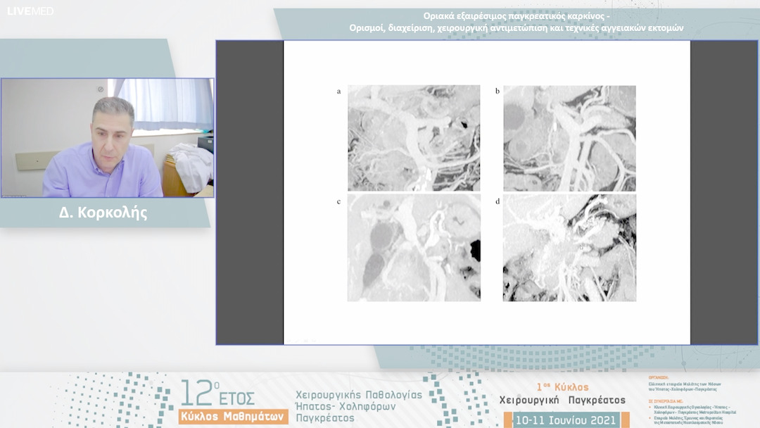 24 Δ. Κορκολής - Οριακά εξαιρέσιμος παγκρεατικός καρκίνος - Ορισμοί, διαχείριση, χειρουργική αντιμετώπιση και τεχνικές αγγειακών εκτομών