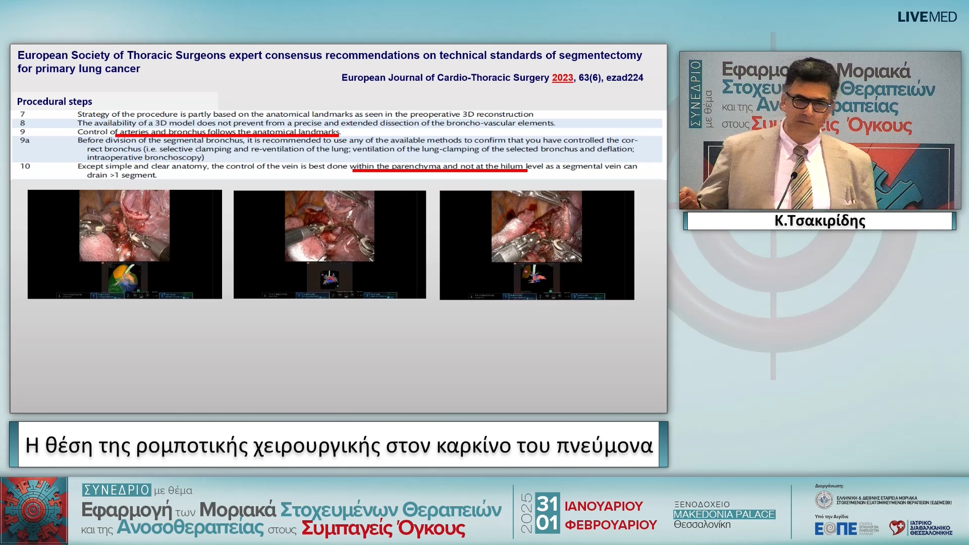 17 Κ. Τσακιρίδης - Η θέση της ρομποτικής χειρουργικής στον καρκίνο του πνεύμονα 