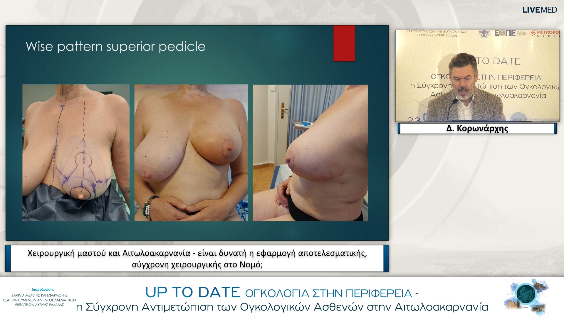 37 Δ. Κορωνάρχης - Χειρουργική μαστού και Αιτωλοακαρνανία - είναι δυνατή η εφαρμογή αποτελεσματικής, σύγχρονη χειρουργικής στο Νομό;